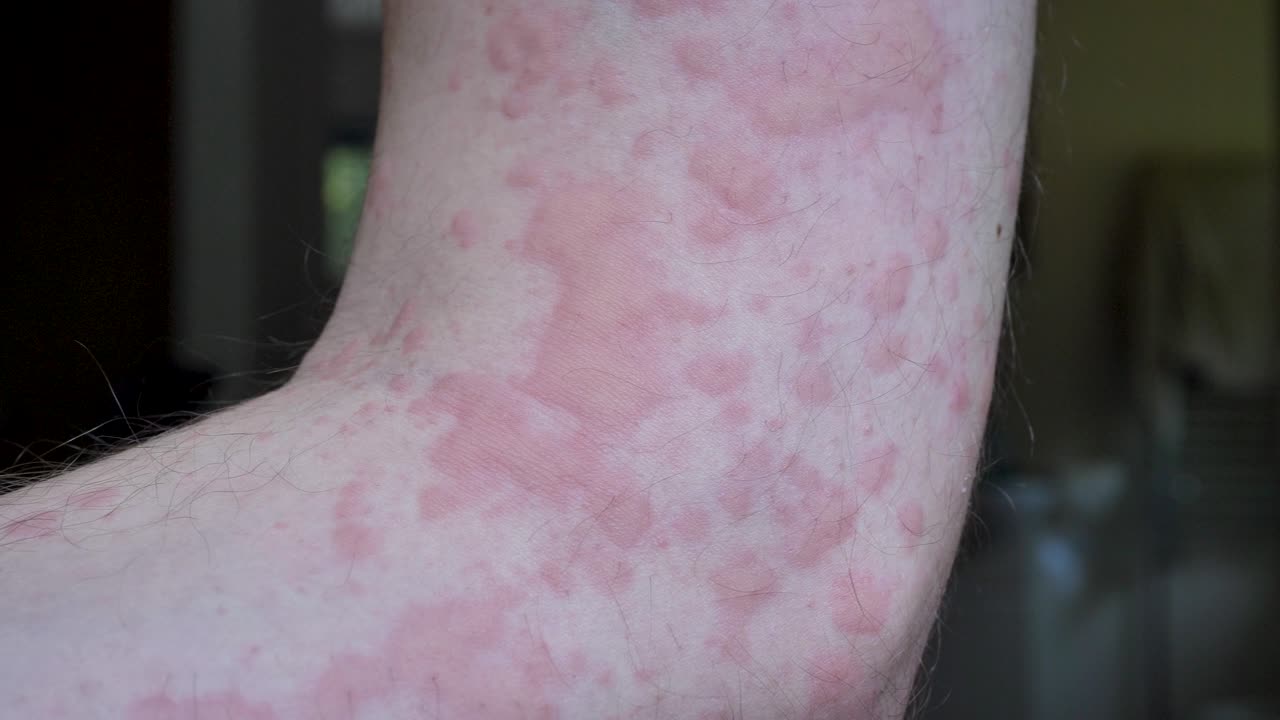 cerca del brote de urticaria en el brazo del hombre caucásico