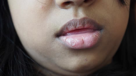 un primer plano de los labios de una persona que muestra sequedad o una posible infección