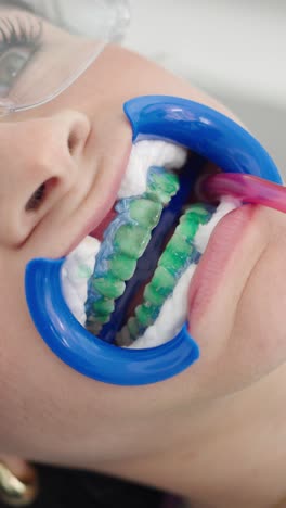 hispanic woman undergoing professional teeth whitening procedure at dental clinic