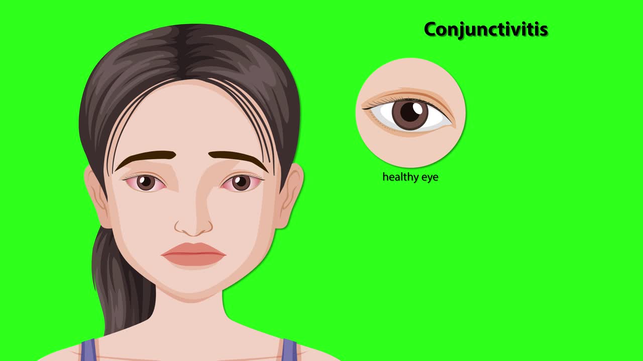 Animated sequence explains conjunctivitis types with labeled eye diagrams beside a concerned girl illustration