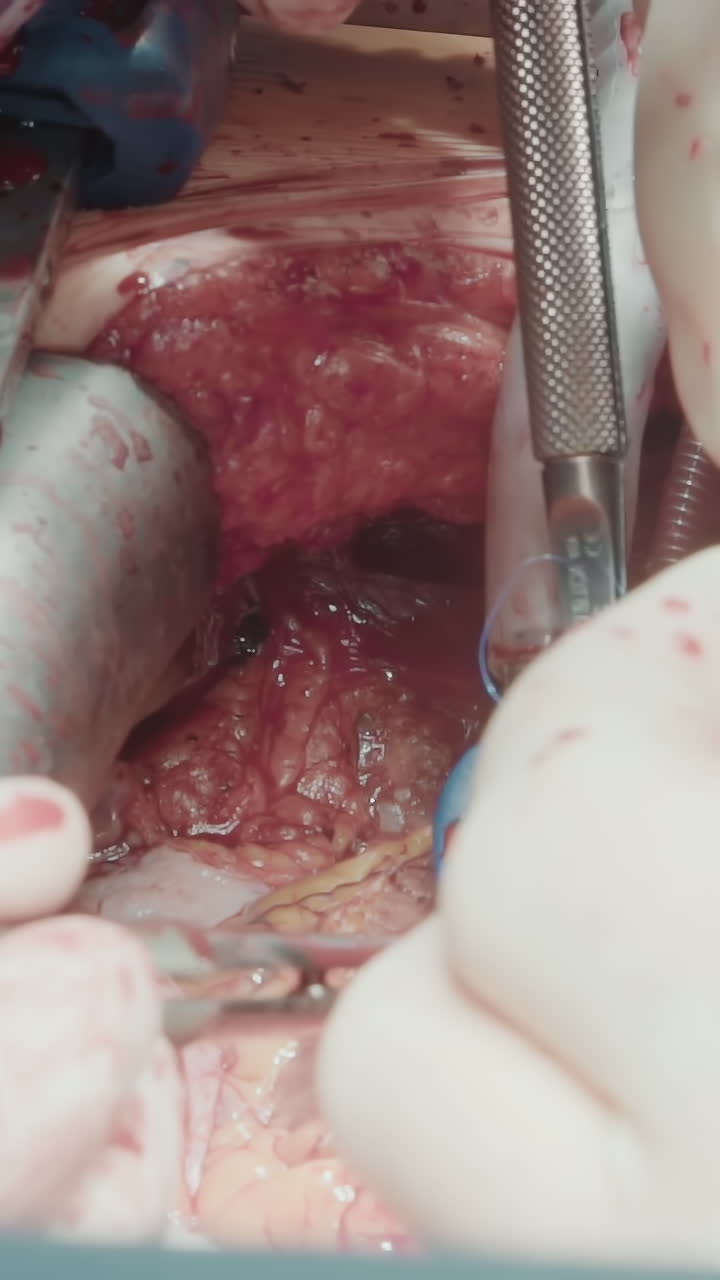 los cirujanos usan herramientas para injertar vasos. los médicos trabajan cuidadosamente en pequeñas arterias coronarias con herramientas que crean nuevas vías para el flujo sanguíneo.