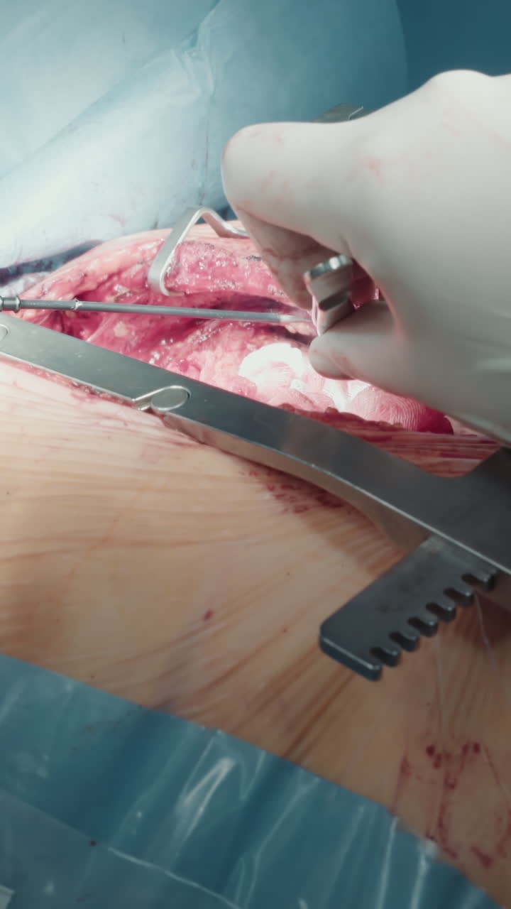 el cirujano realiza un procedimiento con láser en la clínica. el médico experto maniobra las herramientas láser con precisión durante una delicada operación cardíaca en una clínica bien iluminada