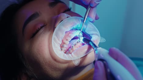 ortodontista ligando aparelhos nos dentes por cura de luz, odontologia