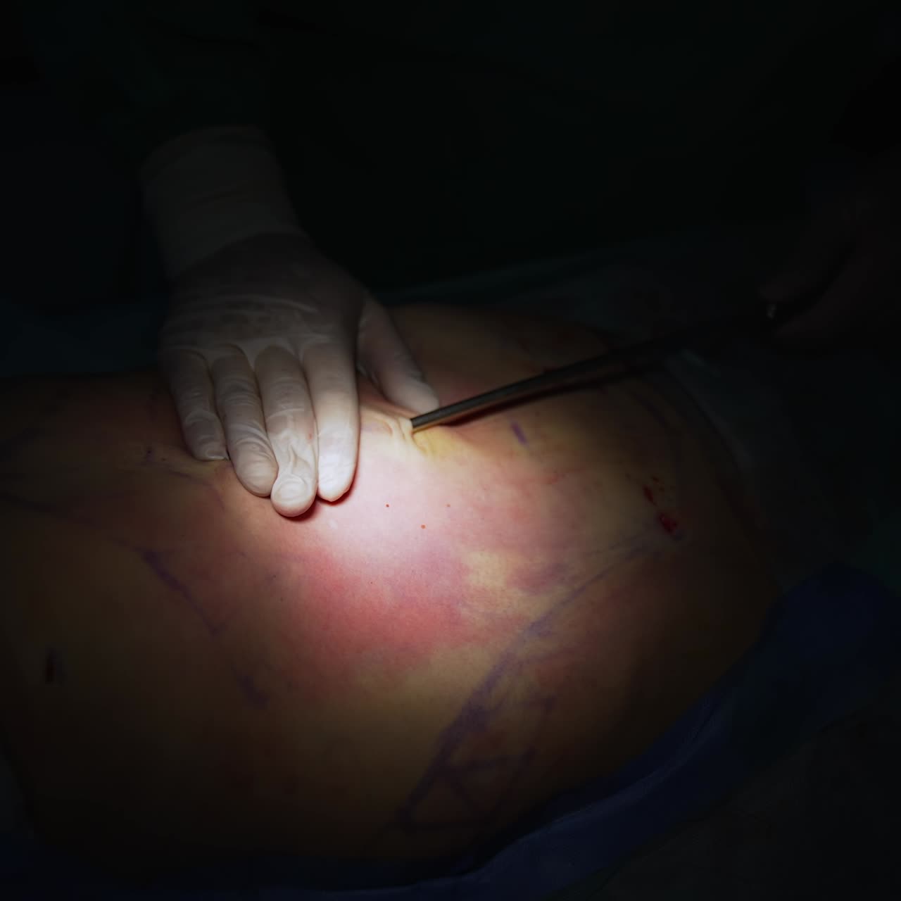 Pumping fat from abdomen. Liposuction process on patient's body. Hands of a doctor collecting fat with surgical tool. Close-up. Light spot