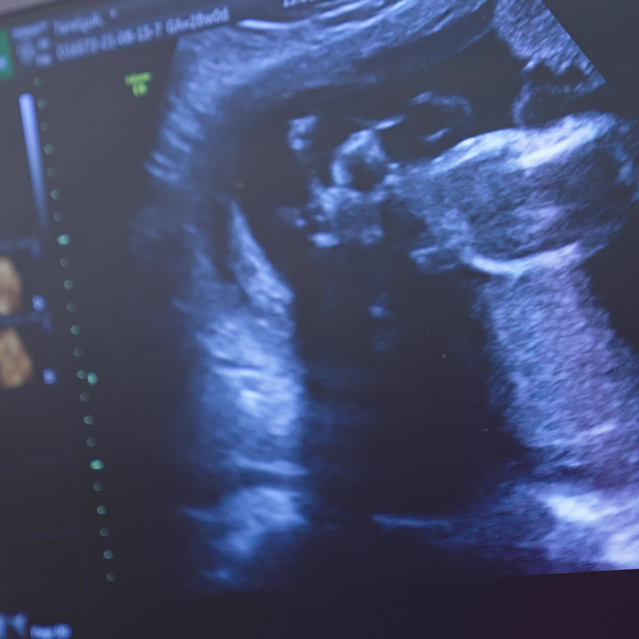 Baby in mother's womb is moving during sonography. Ultrasonography screen