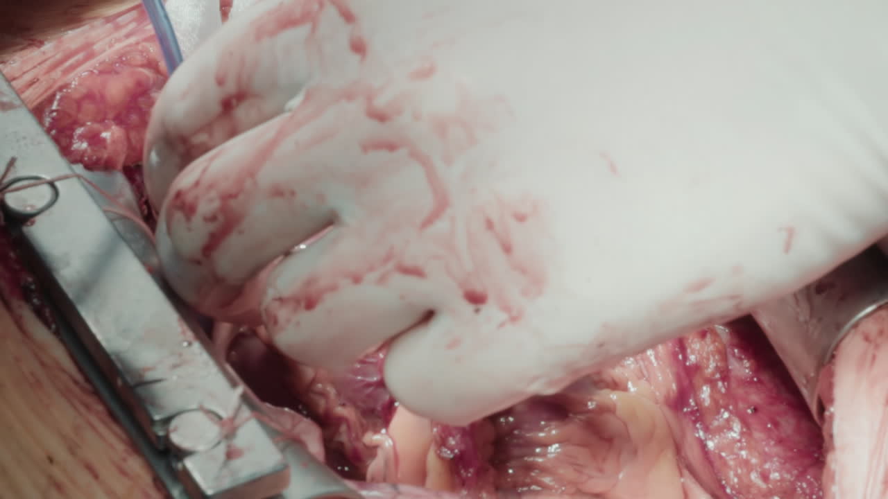 Surgeon hand operates patient heart. Chest cavity opened with rib spreaders for access to pulsating organ for effective grafting harvested vessels closeup