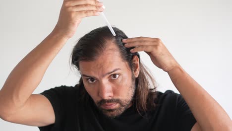 man applying minoxidil to hair with dropper, baldness, scalp health