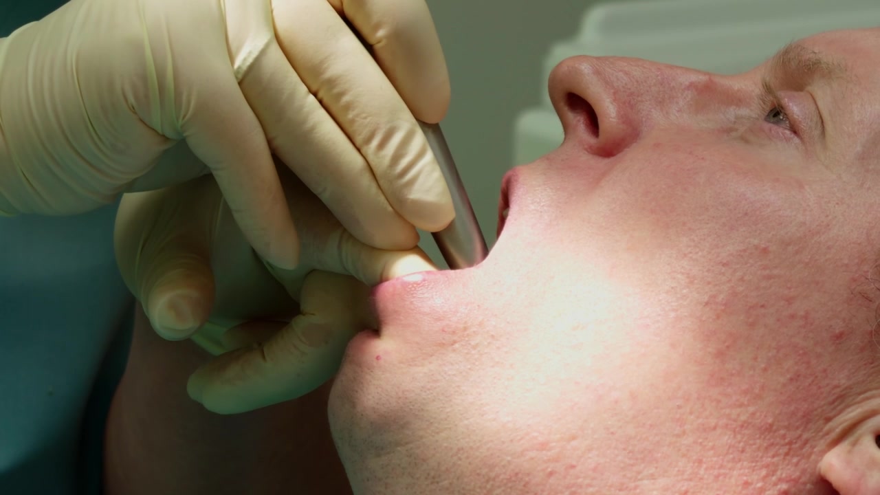 Un primo piano estremo e dettagliato riprende un dentista professionista che utilizza uno strumento di perforazione specializzato all'interno della bocca di un paziente maschio durante un trattamento medico in una clinica luminosa, evidenziando l'assistenza sanitaria