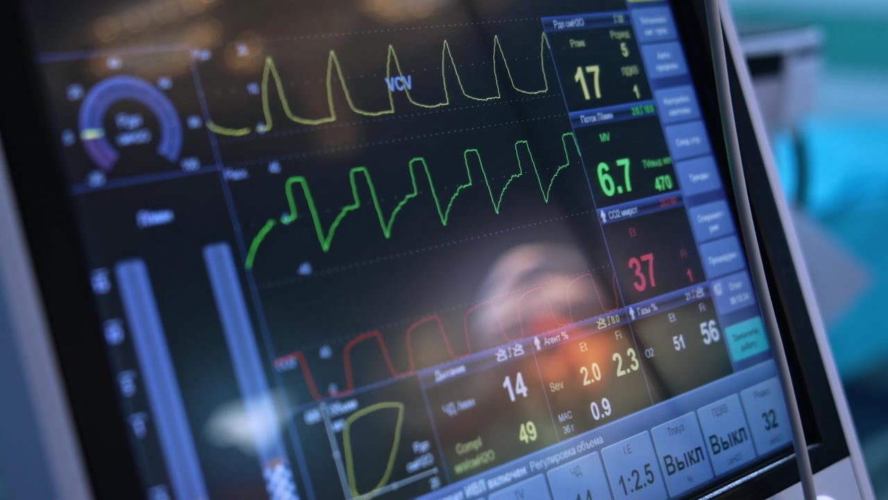 Diverse linee curve e parametri sono visualizzati sul monitor scuro. Schermo del ventilatore polmonare in funzione durante l'operazione. Primo piano.