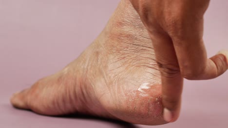 cracked heels and treatment