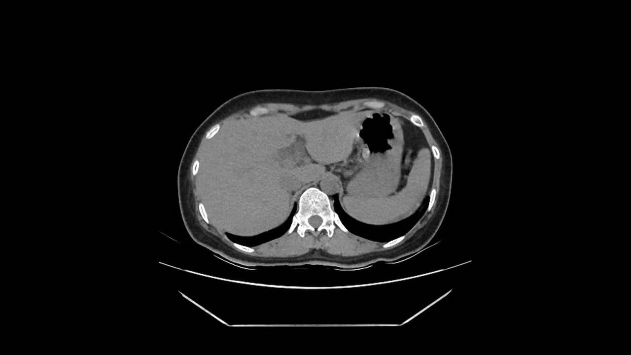Ct scan results for appendicitis and gallstones in patients diagnostic imaging insights and analysis