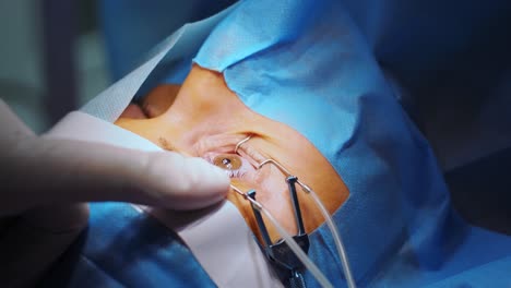 corrección de la visión con láser. un paciente y un equipo de cirujanos en la sala de operaciones durante una cirugía oftalmológica. especulo del párpado. tratamiento de lasik. paciente bajo una cubierta estéril