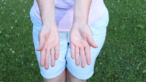 swollen palm due to a bee sting