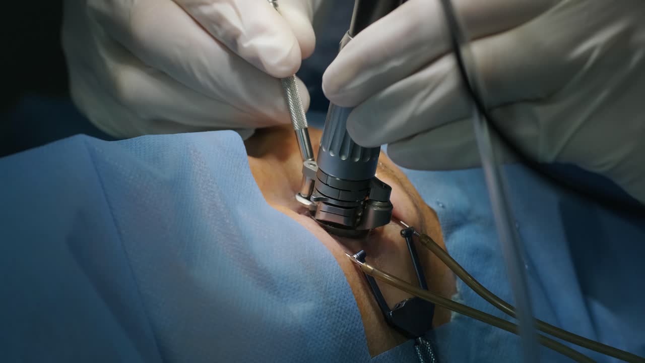 레이저 시력 교정: 안과 수술 중에 수술실에 있는 환자와 수술팀; 눈꺼풀 스럼; 라식 치료; 불임 개 아래의 환자