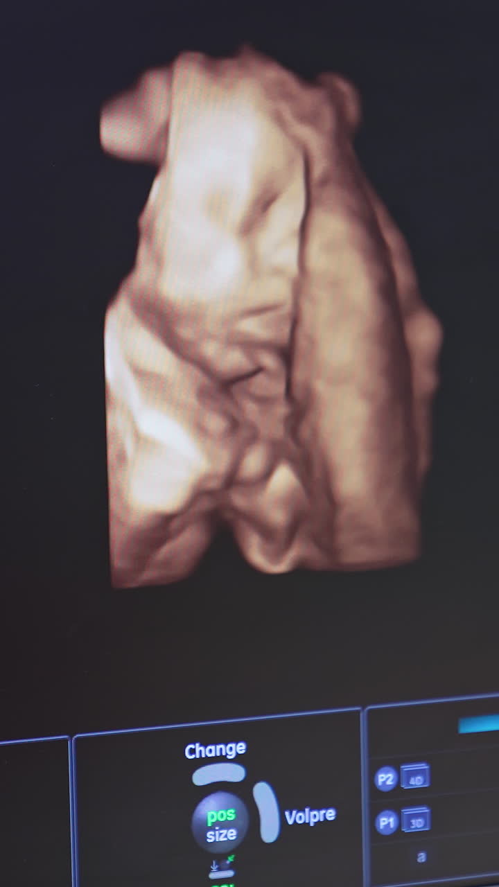 Human embryo is moving his head on an ultrasound display. Ultrasound monitor showing baby body during sonogram procedure to a pregnant woman. Vertical video