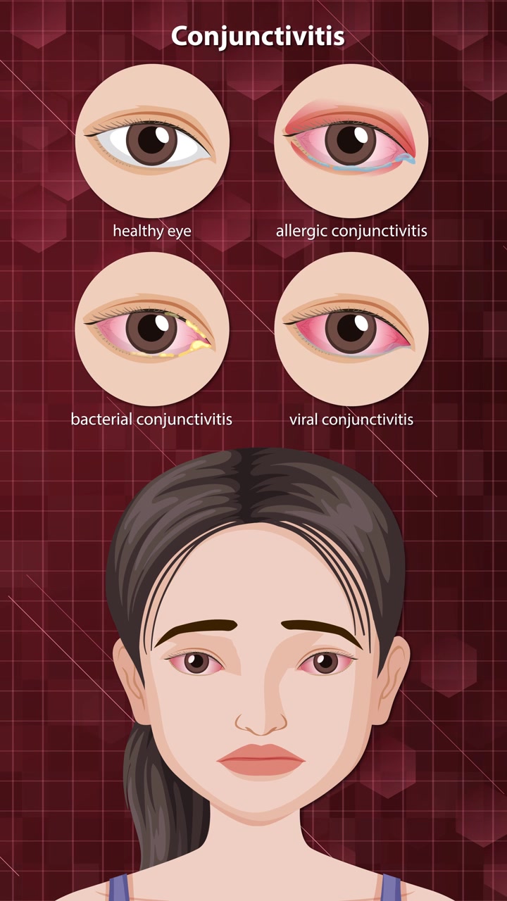 Sequenza animata mostra i sintomi della congiuntivite e confronta condizioni oculari sane, allergiche, batteriche e virali