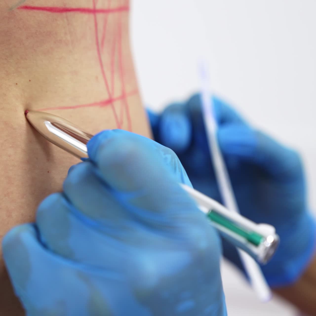 Drawing red lines with a pen on female abdomen. Pierced belly being prepared for liposurgery operation