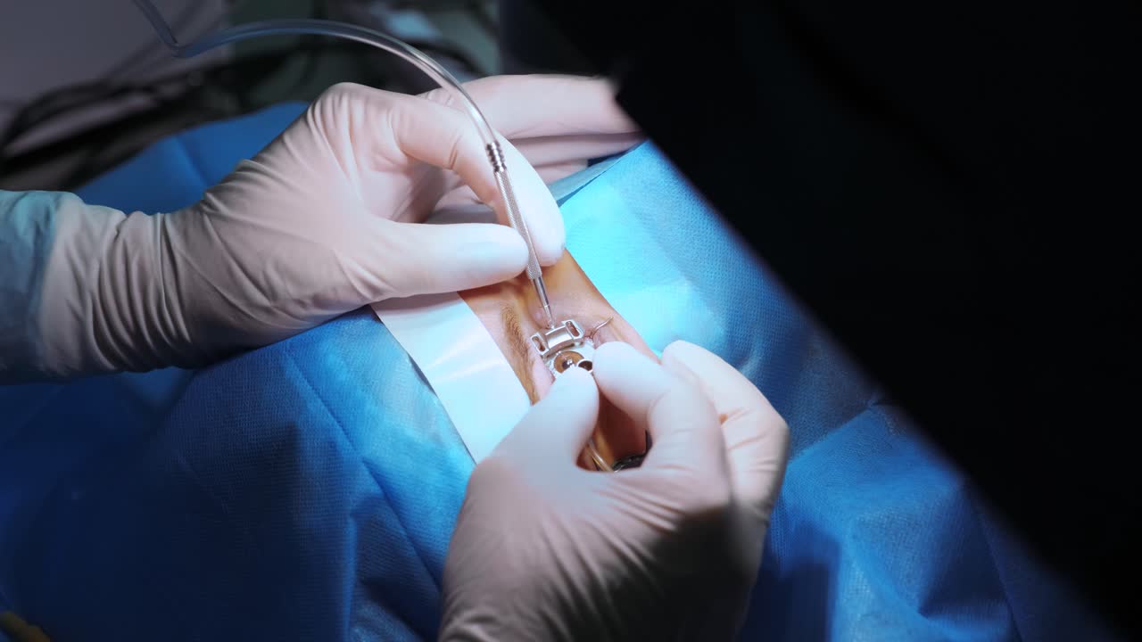 corrección de la visión con láser. un paciente y un equipo de cirujanos en la sala de operaciones durante una cirugía oftalmológica. especulo del párpado. tratamiento de lasik. paciente bajo una cubierta estéril