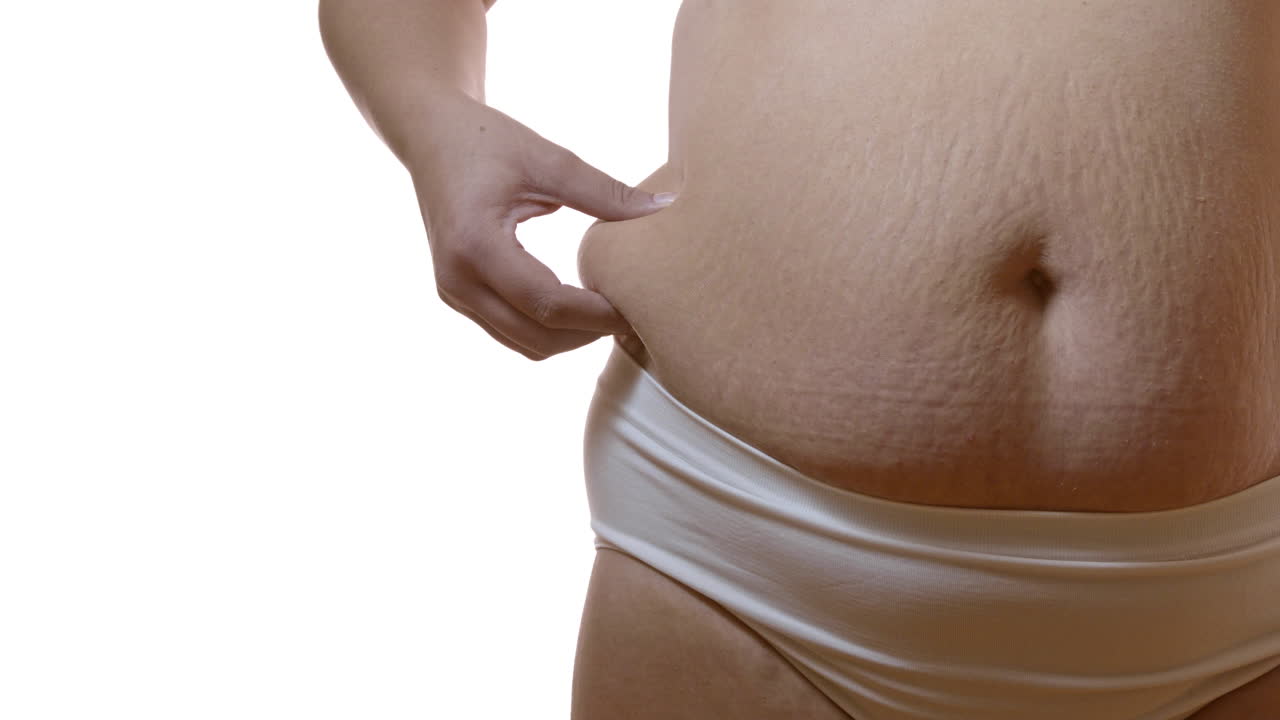 Close up of fat woman's belly after birth with stretch marks and excess fat