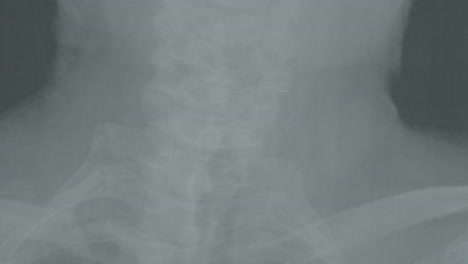cervical spine x-ray