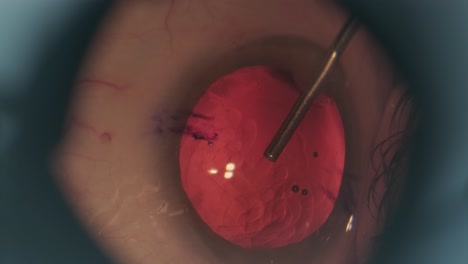 cleaning cataract in the eye. macro footage of eyes during eye surgery. ophthalmological surgery.