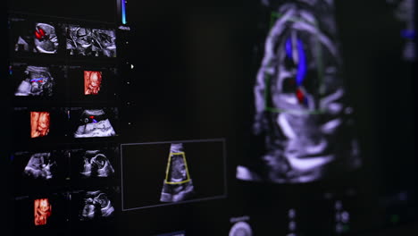 yet unborn child on the ultrasound machine screen. baby development examination on modern equipment.