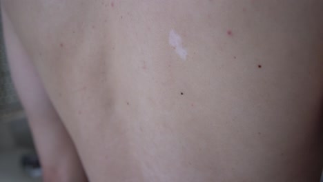 Scar-on-a-man's-back