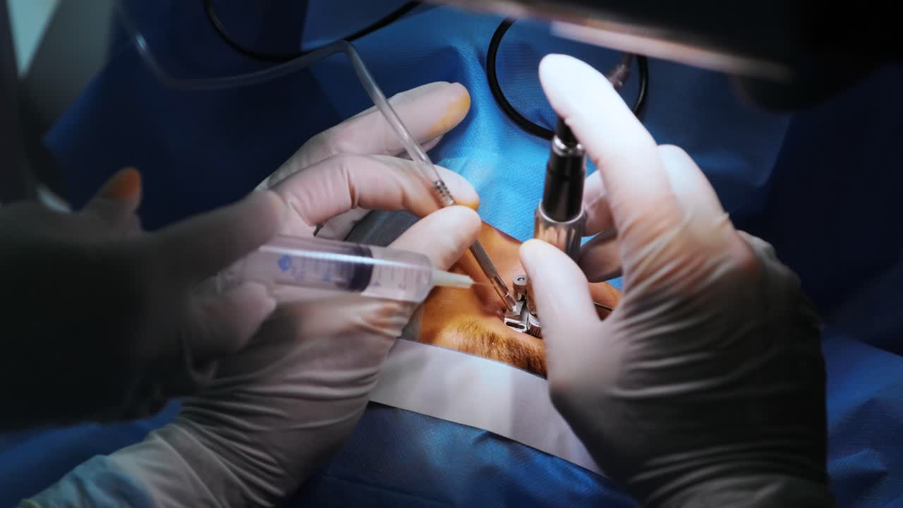 corrección de la visión con láser. un paciente y un equipo de cirujanos en la sala de operaciones durante una cirugía oftalmológica. especulo del párpado. tratamiento de lasik. paciente bajo una cubierta estéril