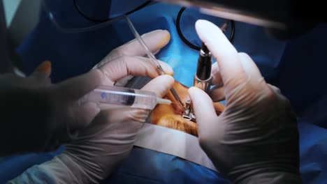 corrección de la visión con láser. un paciente y un equipo de cirujanos en la sala de operaciones durante una cirugía oftalmológica. especulo del párpado. tratamiento de lasik. paciente bajo una cubierta estéril