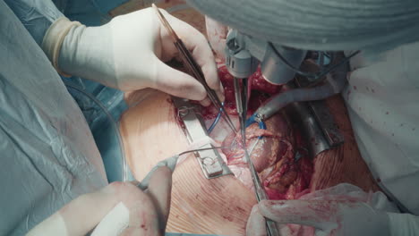 doctors attach graft vessels to artery. experienced cardiothoracic surgeons perform coronary artery bypass surgery using specialized tools closeup