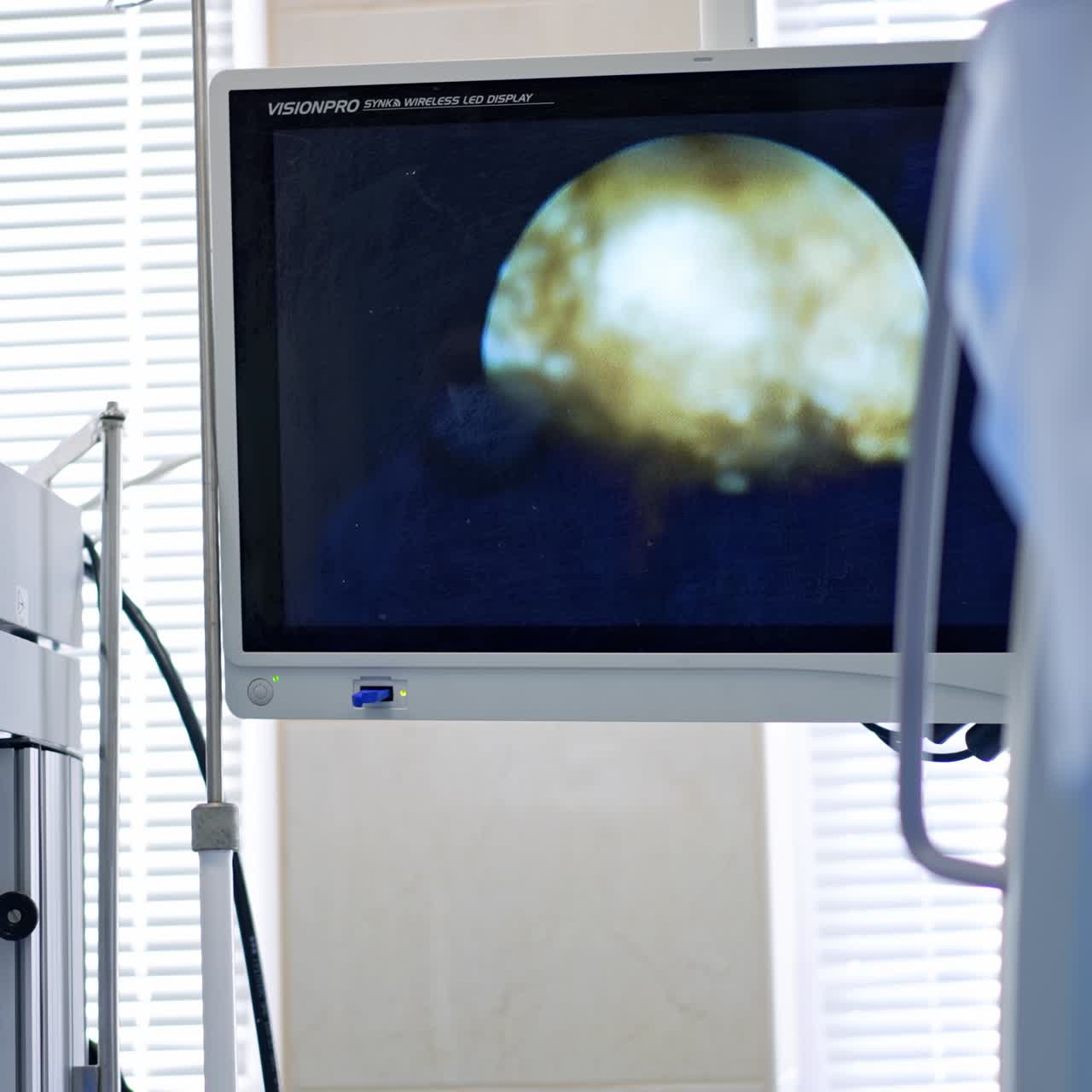 Monitoraggio del progresso della chirurgia endoscopica sullo schermo in sala operatoria. Visualizzazione del funzionamento dello strumento medico sul monitor.