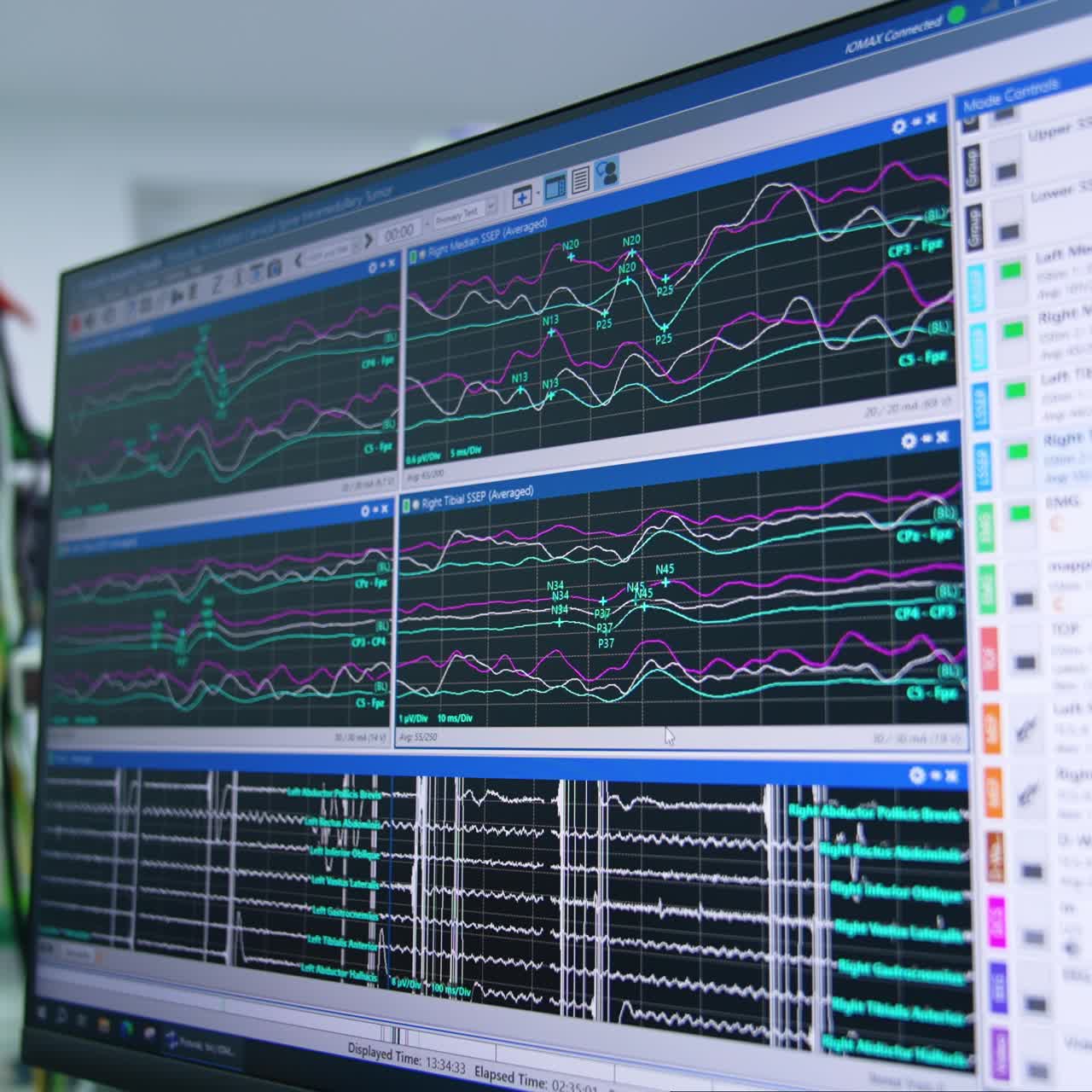 Monitor con più righe in esecuzione. Apparecchiatura medica per il neuromonitoraggio in neurologia. Primo piano