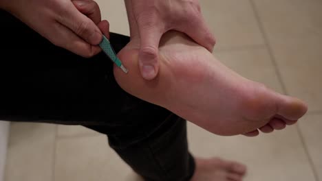 man use scalpel to remove foot wart from his heel, close up