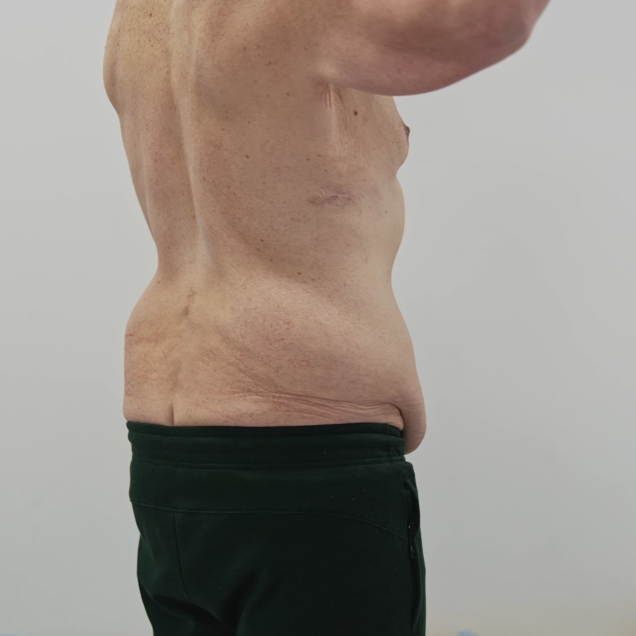 Paziente con cedimenti del corpo. Uomo prima della liposuzione in clinica. Uomo che mostra le parti problematiche del suo corpo dopo aver perso peso