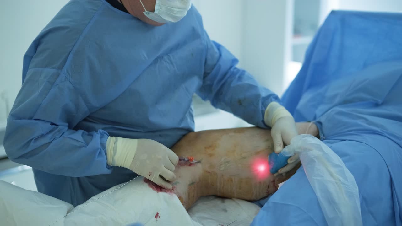 aplicación de bioglue en el tratamiento quirúrgico de la úlcera de la pierna