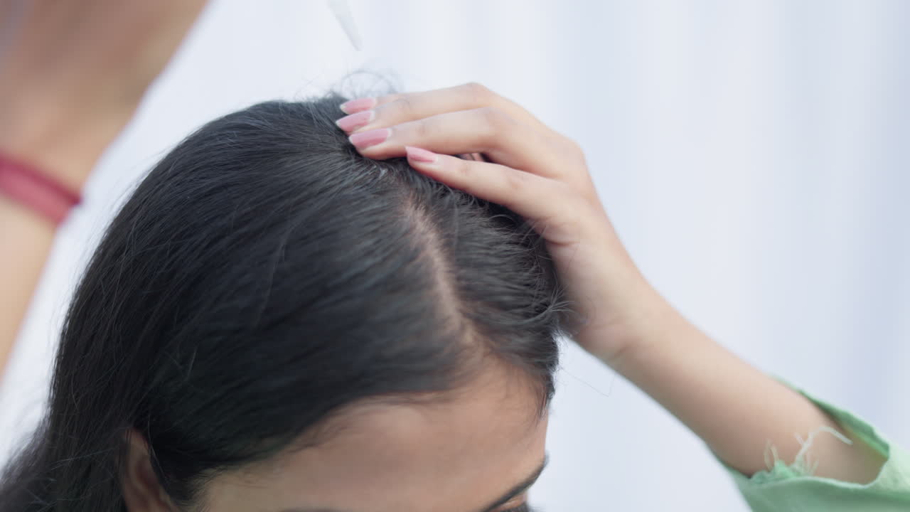 Androgenic alopecia, essential oil, a woman applying hair serum with a dropper on her scalp and massaging to treat hairloss.