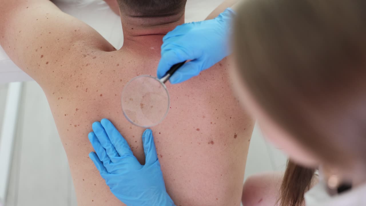 Dermatologist examining moles on a patient's back
