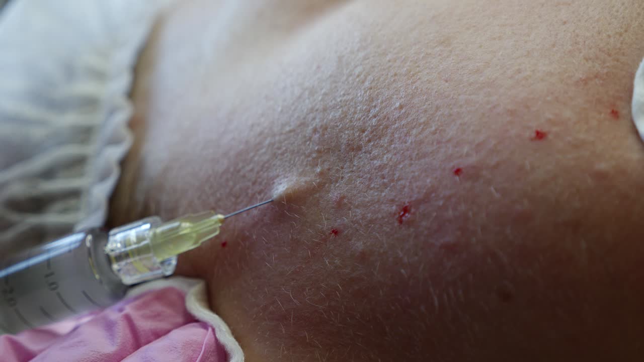 Dermal Filler Injection for Facial Rejuvenation