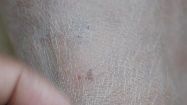 Primo piano della gamba di una persona con pelle secca e dito che tocca la pelle