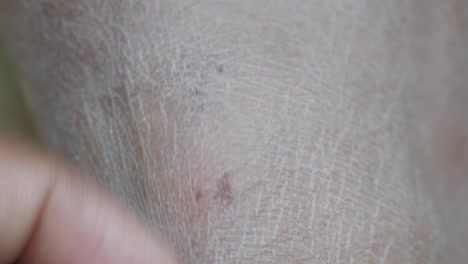 close-up view of a person's leg with dry skin and finger touching the skin