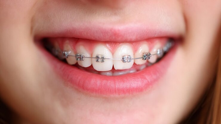 A Close-Up View of a Smiling Person's Braces, Showcasing the Transformation of Their Smile and Dental Alignment Progress Over Time
