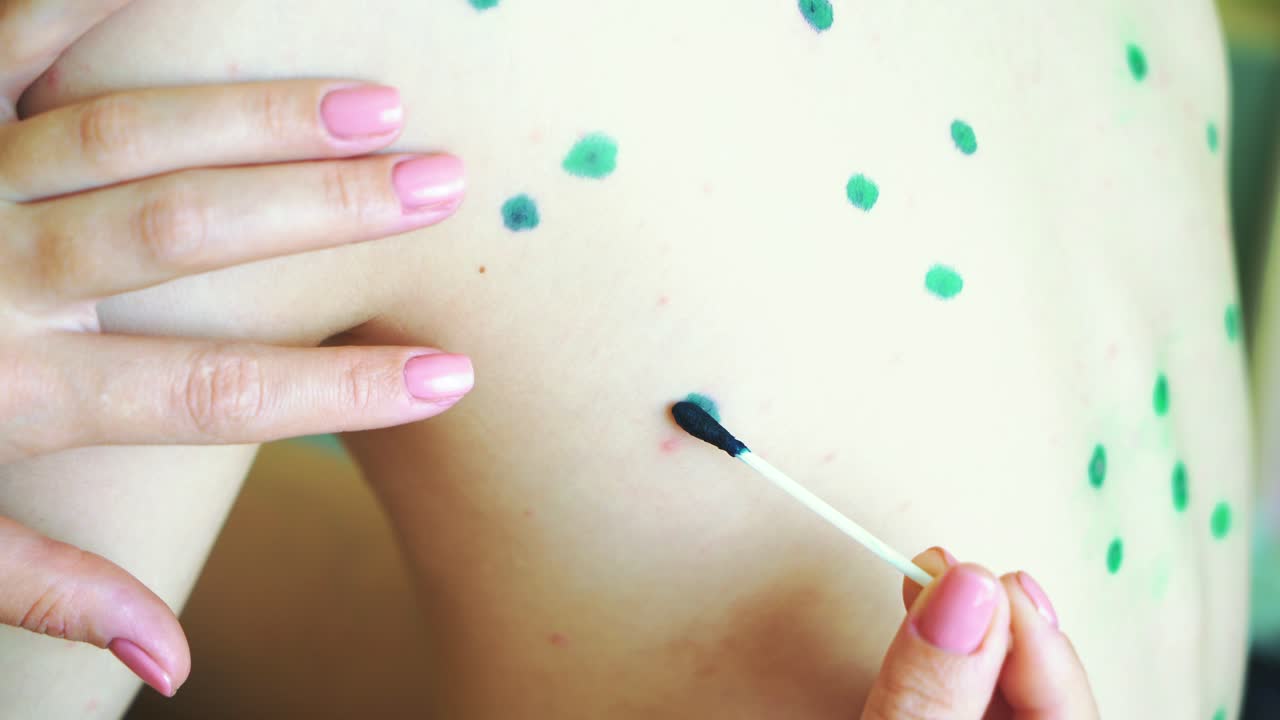 Little boy with chickenpox. Mother applying antiseptic solution to rash. Home treatment.