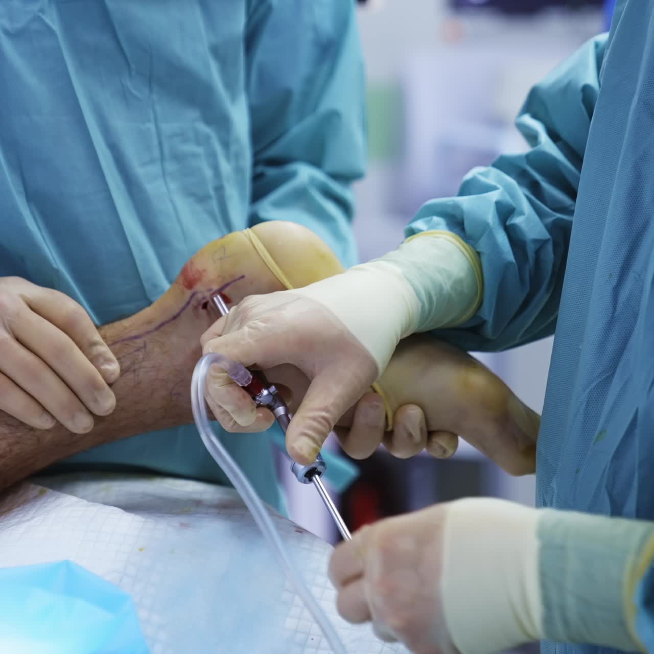Intervento chirurgico alla gamba del paziente. Medici in uniforme medica conducono un'operazione utilizzando strumenti chirurgici. Primo piano.