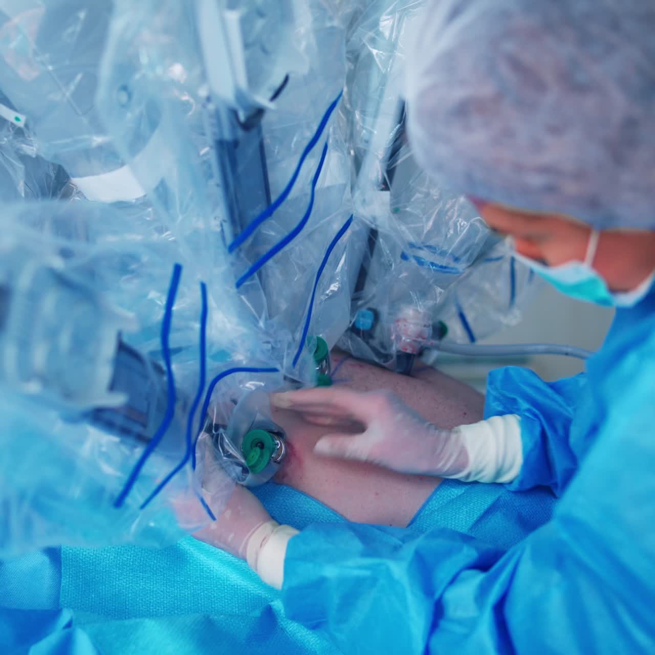 Team surgeon at work in operating room. Modern equipment in operating room. Surgical treatment of cancer