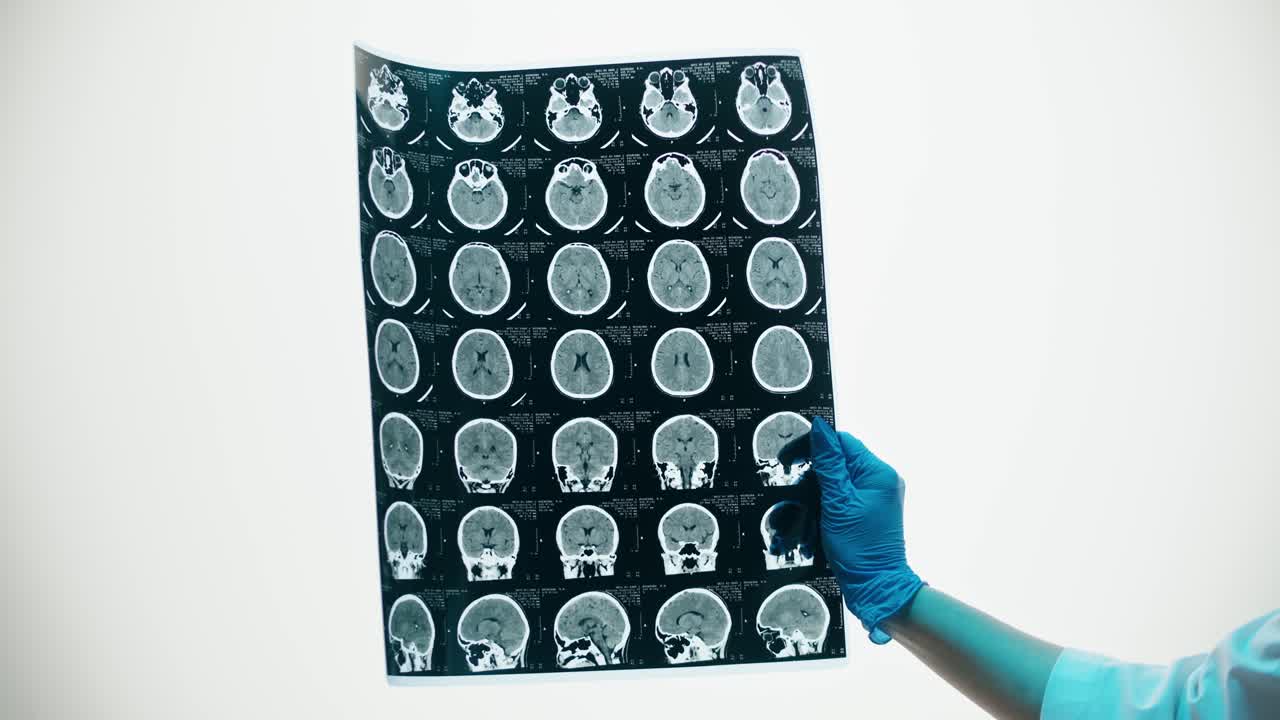 Mano guantata che tiene ed esamina una scansione medica del cervello umano