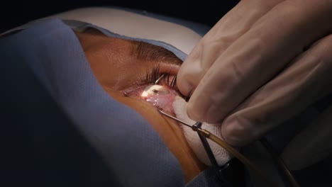 laser vision correction. a patient and team of surgeons in the operating room during ophthalmic surgery. eyelid speculum. lasik treatment. patient under sterile cover