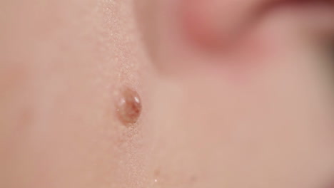 Macro-shot-of-mole-on-human-skin