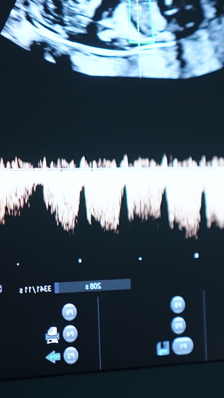 Screen of ultrasonic machine at work. Image of baby and life parameters on the monitor. Sonography of pregnant. Vertical video