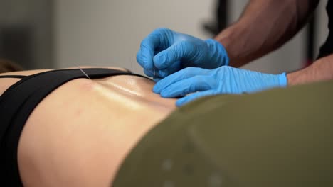 anonymous doctor performing acupuncture on back of female patient