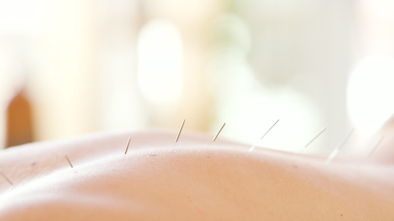 Closeup of back with acupuncture needles